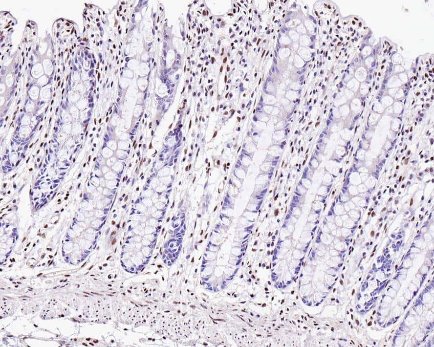 Immunohistochemistry: ZEB1 Antibody (PSH0-61) [NBP3-33133] - Immunohistochemical analysis of paraffin-embedded human colon tissue with Rabbit anti-ZEB1 antibody (NBP3-33133) at 1/1,000 dilution. The section was pre-treated using heat mediated antigen retrieval with sodium citrate buffer (pH 6.0) for 2 minutes. The tissues were blocked in 1% BSA for 20 minutes at room temperature, washed with ddH2O and PBS, and then probed with the primary antibody (NBP3-33133) at 1/1,000 dilution for 1 hour at room temperature. The detection was performed using an HRP conjugated compact polymer system. DAB was used as the chromogen. Tissues were counterstained with hematoxylin and mounted with DPX.