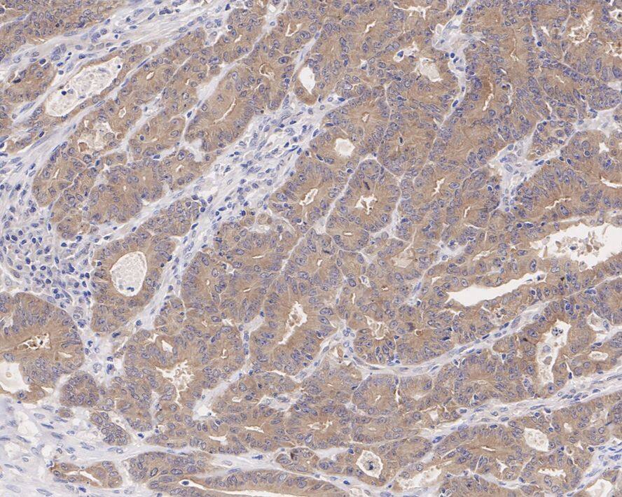 Immunohistochemistry: CSNK1A1/CSNK1A1L Antibody (PSH04-58) [NBP3-33146] - Immunohistochemical analysis of paraffin-embedded human colon cancer tissue with Rabbit anti-CSNK1A1/CSNK1A1L antibody (NBP3-33146) at 1/1,000 dilution. The section was pre-treated using heat mediated antigen retrieval with Tris-EDTA buffer (pH 9.0) for 20 minutes. The tissues were blocked in 1% BSA for 20 minutes at room temperature, washed with ddH2O and PBS, and then probed with the primary antibody (NBP3-33146) at 1/1,000 dilution for 1 hour at room temperature. The detection was performed using an HRP conjugated compact polymer system. DAB was used as the chromogen. Tissues were counterstained with hematoxylin and mounted with DPX.