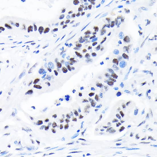 Immunohistochemistry: SUPT5H Antibody (9V9G7) [NBP3-33195] - Immunohistochemistry analysis of paraffin-embedded Human colon carcinoma using SUPT5H Rabbit mAb at dilution of 1:100 (40x lens). Microwave antigen retrieval performed with 0.01M Tris/EDTA Buffer (pH 9.0) prior to IHC staining.