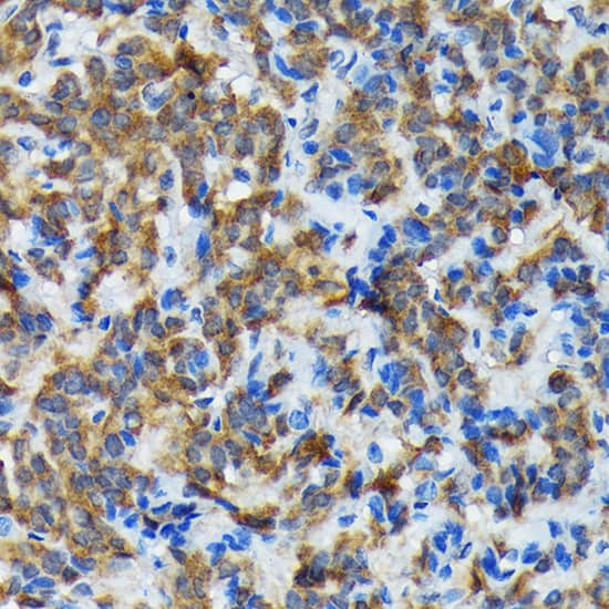 Immunohistochemistry: Thyroid Peroxidase Antibody (3C4A4) [NBP3-33200] - Immunohistochemistry analysis of paraffin-embedded Human thyroid cancer using Thyroid Peroxidase Rabbit mAb at dilution of 1:100 (40x lens). Microwave antigen retrieval performed with 0.01M Tris/EDTA Buffer (pH 9.0) prior to IHC staining.