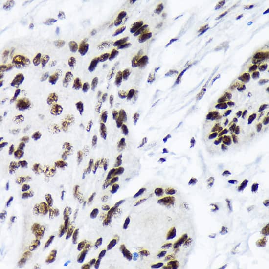 Immunohistochemistry: ARID1A Antibody (9D4J6) [NBP3-33201] - Immunohistochemistry analysis of paraffin-embedded Human esophageal cancer using ARID1A Rabbit mAb at dilution of 1:100 (40x lens). Microwave antigen retrieval performed with 0.01M Tris/EDTA Buffer (pH 9.0) prior to IHC staining.