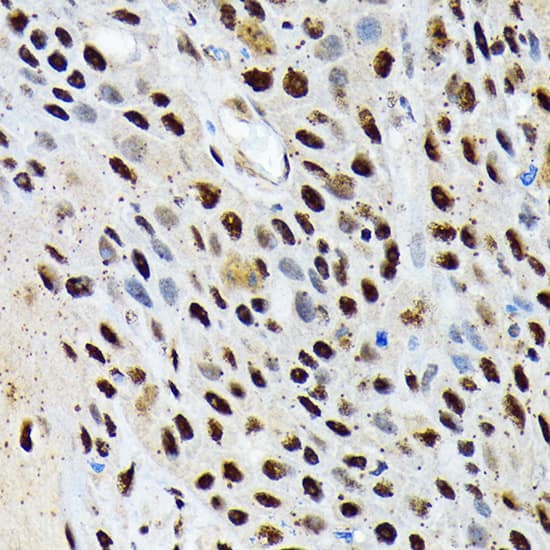 Immunohistochemistry: ENT2 Antibody (7B2J3) [NBP3-33206] - Immunohistochemistry analysis of paraffin-embedded Human esophageal cancer using ENT2 Rabbit mAb at dilution of 1:100 (40x lens). Microwave antigen retrieval performed with 0.01M Tris/EDTA Buffer (pH 9.0) prior to IHC staining.