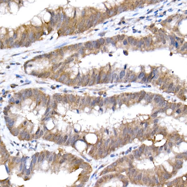 Immunohistochemistry: UbcH5a/UBE2D1 Antibody (8E6O0) [NBP3-33268] - Immunohistochemistry analysis of paraffin-embedded Human colon carcinoma using UbcH5a/UBE2D1 Rabbit mAb at dilution of 1:50 (40x lens). High pressure antigen retrieval performed with 0.01M Citrate Bufferr (pH 6.0) prior to IHC staining.