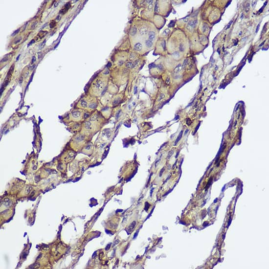 Immunohistochemistry: AKT1/2 Antibody (1G0K5) [NBP3-33526] - Immunohistochemistry analysis of paraffin-embedded Human lung cancer using AKT1/2 Rabbit mAb at dilution of 1:100 (40x lens). High pressure antigen retrieval performed with 0.01M Citrate Bufferr (pH 6.0) prior to IHC staining.