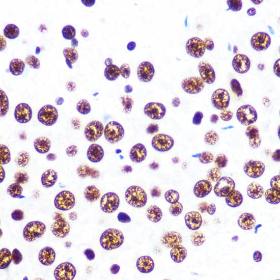 Immunohistochemistry: SFPQ Antibody (8Y5S6) [NBP3-33527] - Immunohistochemistry analysis of paraffin-embedded Human breast cancer tissue using SFPQ Rabbit mAb  at a dilution of 1:200 (40x lens). High pressure antigen retrieval was performed with 0.01 M citrate buffer (pH 6.0) prior to IHC staining.