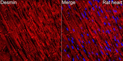 Immunohistochemistry: Desmin Antibody (6O9O4) [NBP3-33531] - Immunohistochemistry analysis of paraffin-embedded Human prostate cancer tissue using Desmin Rabbit mAb  at a dilution of 1:1600 (40x lens). High pressure antigen retrieval was performed with 0.01 M Tris-EDTA buffer (pH 9.0) prior to IHC staining.