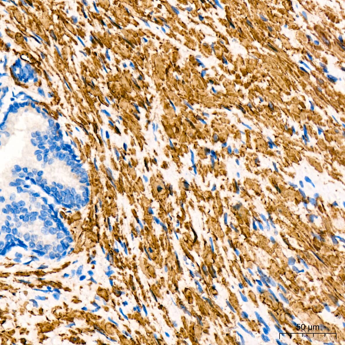 Immunohistochemistry: Desmin Antibody (6O9O4) [NBP3-33531] - Immunohistochemistry analysis of paraffin-embedded Human prostate cancer tissue using Desmin Rabbit mAb at a dilution of 1:1600 (40x lens). High pressure antigen retrieval was performed with 0.01 M Tris-EDTA buffer (pH 9.0) prior to IHC staining.