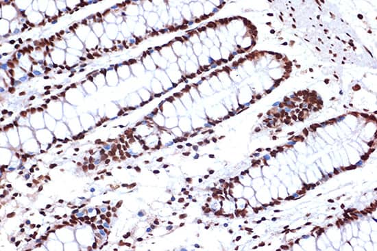 Immunohistochemistry: FUBP1 Antibody (1G6X5) [NBP3-33539] - Immunohistochemistry analysis of paraffin-embedded Human breast cancer tissue using FUBP1 Rabbit mAb  at a dilution of 1:200 (40x lens). High pressure antigen retrieval was performed with 0.01 M citrate buffer (pH 6.0) prior to IHC staining.