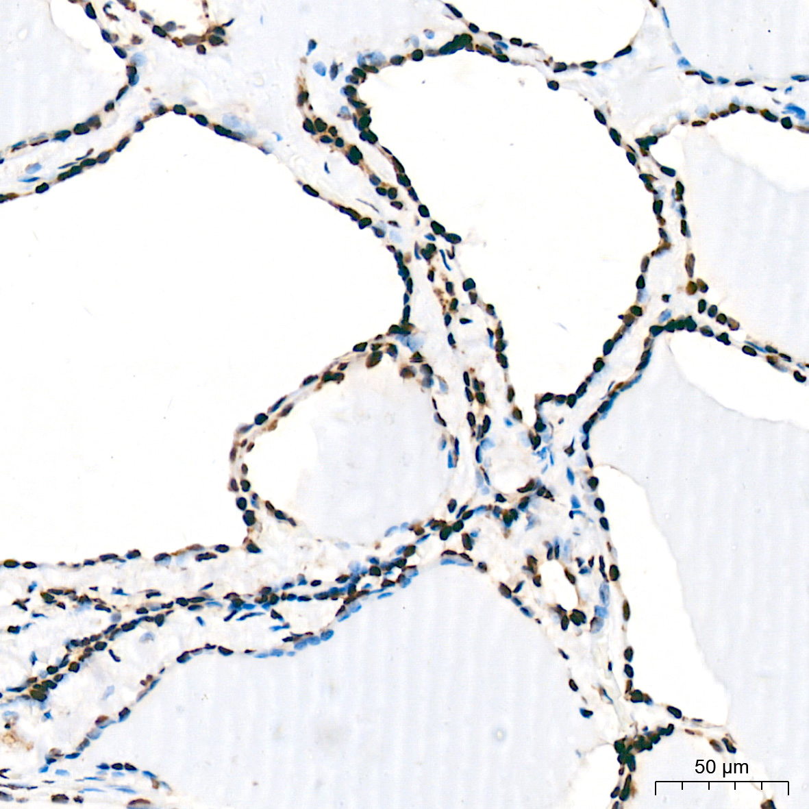 Immunohistochemistry: FUBP1 Antibody (1G6X5) [NBP3-33539] - Immunohistochemistry analysis of FUBP1 in paraffin-embedded human thyroid tissue using FUBP1 Rabbit mAb at a dilution of 1:200 (40x lens). High pressure antigen retrieval was performed with 0.01 M citrate buffer (pH 6.0) prior to IHC staining.