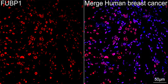 Immunocytochemistry/ Immunofluorescence: FUBP1 Antibody (1G6X5) [NBP3-33539] - Confocal imaging of paraffin-embedded Human breast cancer tissue using FUBP1 Rabbit mAb followed by a further incubation with Cy3 Goat Anti-Rabbit IgG (H+L) (Red). DAPI was used for nuclear staining (Blue). Objective: 40x. Perform high pressure antigen retrieval with 0.01 M citrate buffer (pH 6.0) prior to IF staining.