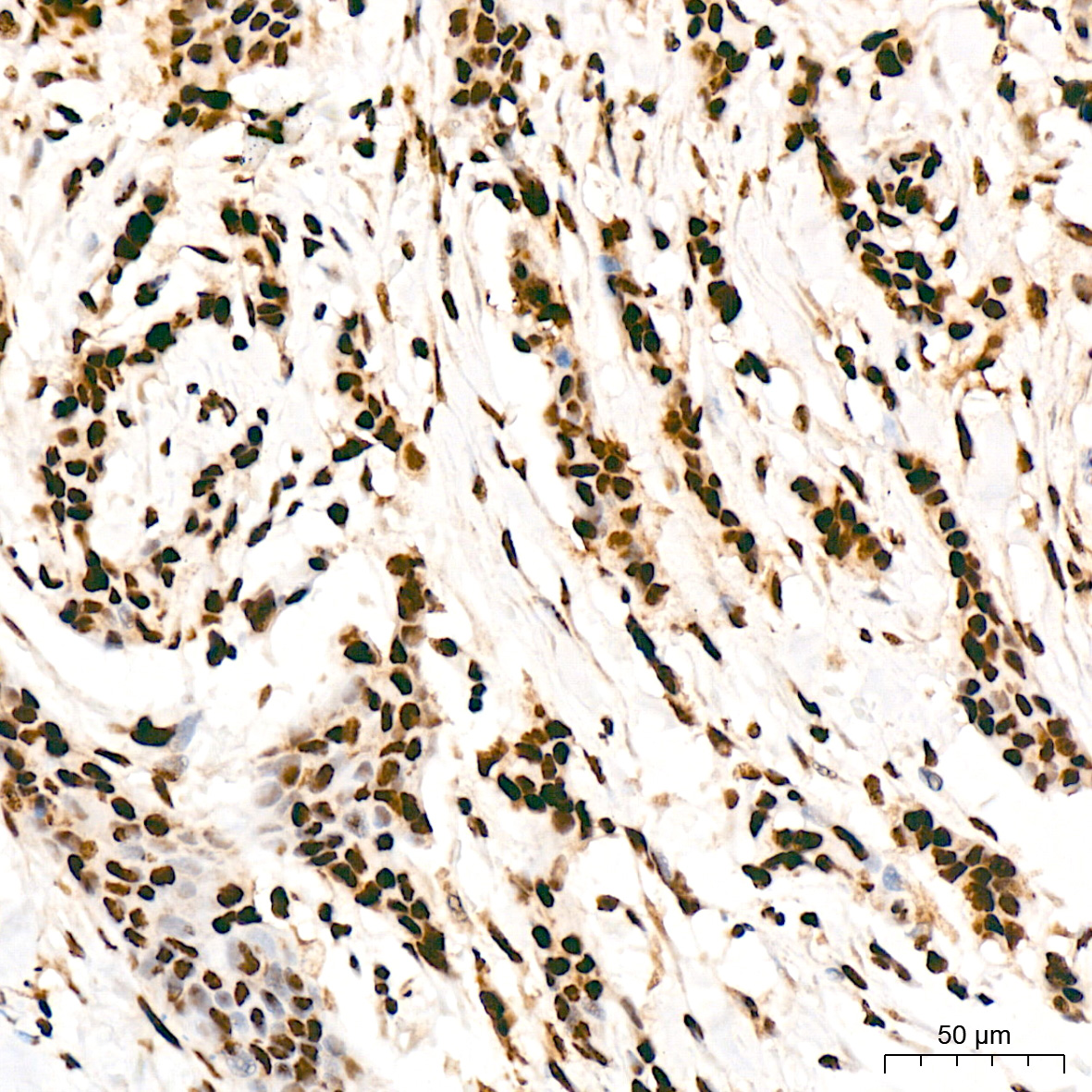 Immunohistochemistry: FUBP1 Antibody (1G6X5) [NBP3-33539] - Immunohistochemistry analysis of FUBP1 in paraffin-embedded human breast cancer tissue using FUBP1 Rabbit mAb at a dilution of 1:200 (40x lens). High pressure antigen retrieval was performed with 0.01 M citrate buffer (pH 6.0) prior to IHC staining.