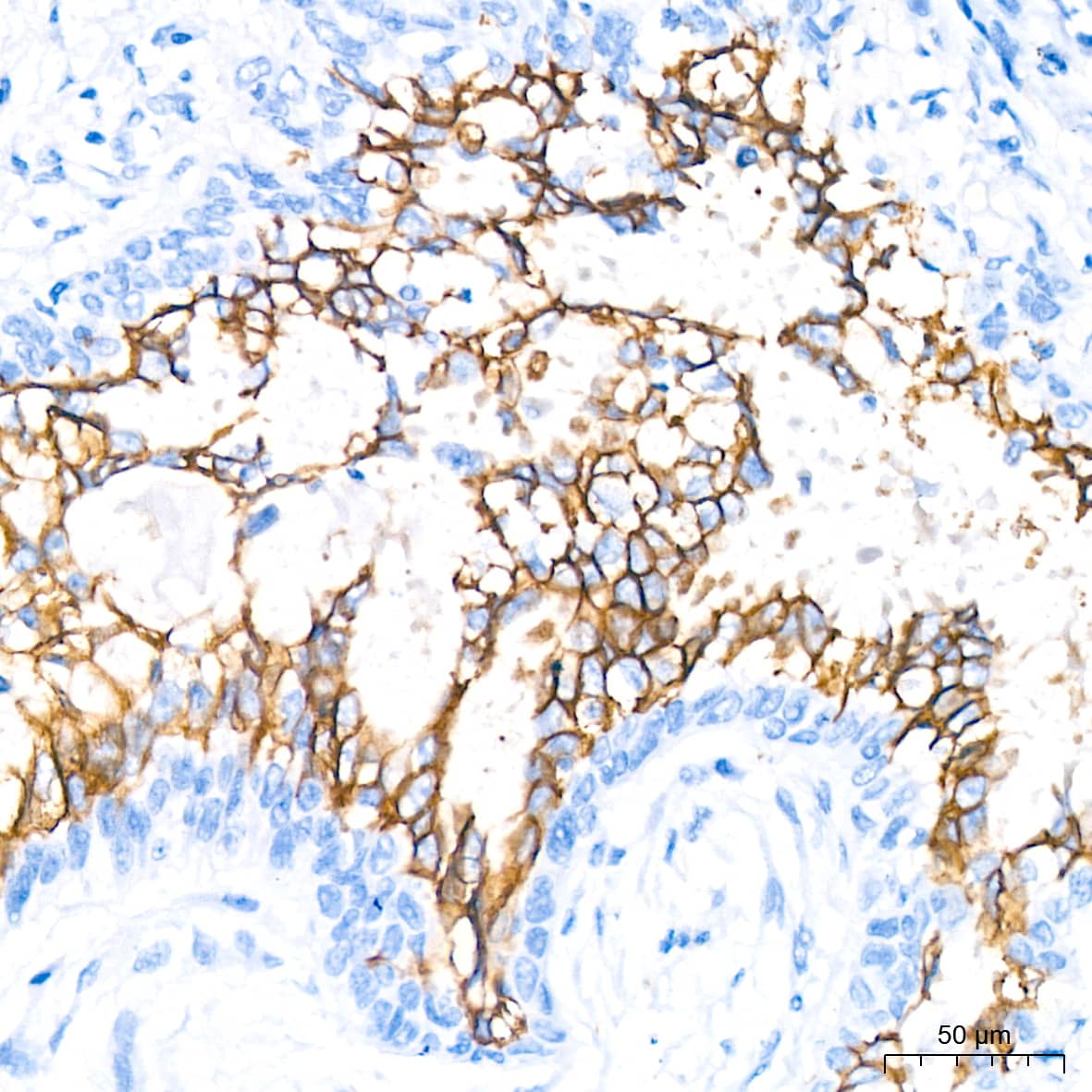 Immunohistochemistry: Aquaporin-4 Antibody (5A4W4) [NBP3-35055] - Immunohistochemistry analysis of paraffin-embedded Human lung cancer tissue using Aquaporin-4 Rabbit mAb at a dilution of 1:200 (40x lens). High pressure antigen retrieval performed with 0.01M Citrate Bufferr (pH 6.0) prior to IHC staining.