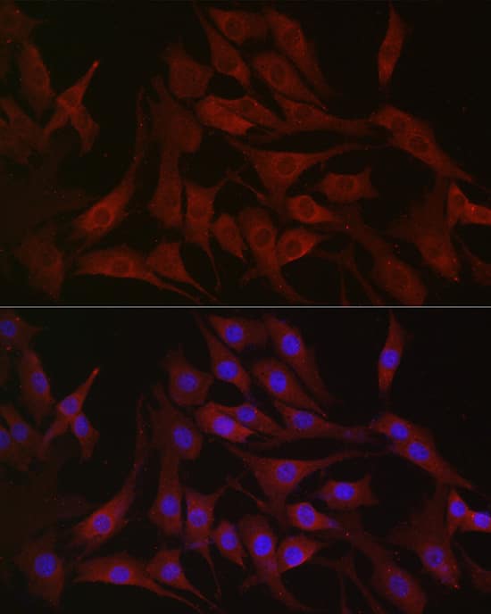 Immunohistochemistry: PIK3CA Antibody [NBP3-35070] - Immunohistochemistry analysis of paraffin-embedded Human breast cancer using PIK3CA Rabbit pAb at dilution of 1:100 (40x lens). High pressure antigen retrieval performed with 0.01M Citrate Bufferr (pH 6.0) prior to IHC staining.