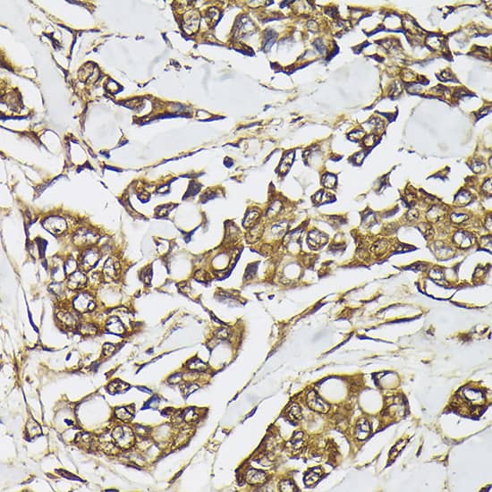 Immunohistochemistry: PIK3CA Antibody [NBP3-35070] - Immunohistochemistry analysis of paraffin-embedded Human breast cancer using PIK3CA Rabbit pAb at dilution of 1:100 (40x lens). High pressure antigen retrieval performed with 0.01M Citrate Bufferr (pH 6.0) prior to IHC staining.