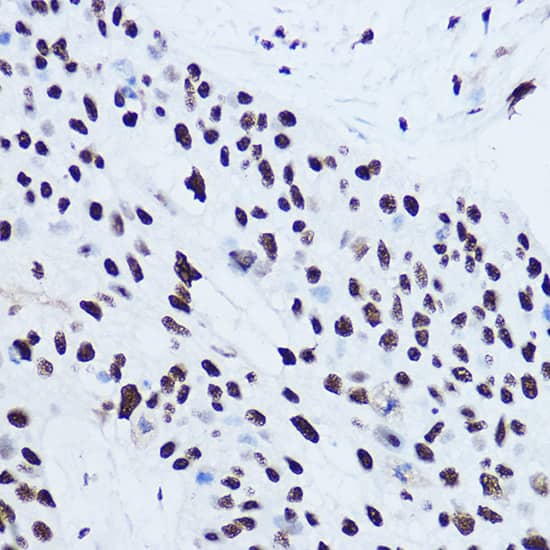 Immunohistochemistry: SSB Antibody [NBP3-35080] - Immunohistochemistry analysis of paraffin-embedded Human lung cancer using SSB Rabbit pAb at dilution of 1:300 (40x lens). High pressure antigen retrieval performed with 0.01M Citrate Bufferr (pH 6.0) prior to IHC staining.