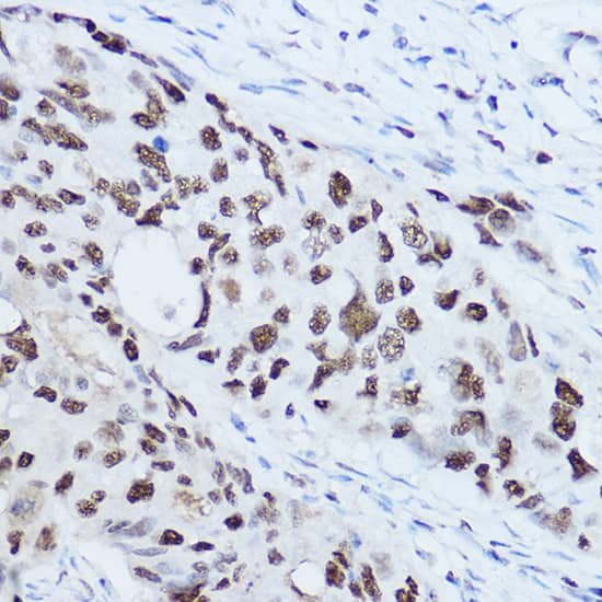 Immunohistochemistry: SSB Antibody [NBP3-35080] - Immunohistochemistry analysis of paraffin-embedded Human breast cancer using SSB Rabbit pAb at dilution of 1:300 (40x lens). High pressure antigen retrieval performed with 0.01M Citrate Bufferr (pH 6.0) prior to IHC staining.