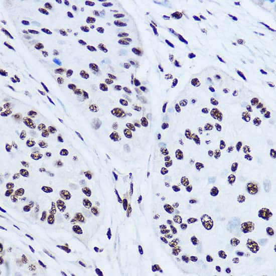 Immunohistochemistry: SSB Antibody [NBP3-35080] - Immunohistochemistry analysis of paraffin-embedded Human esophageal cancer using SSB Rabbit pAb at dilution of 1:300 (40x lens). High pressure antigen retrieval performed with 0.01M Citrate Bufferr (pH 6.0) prior to IHC staining.