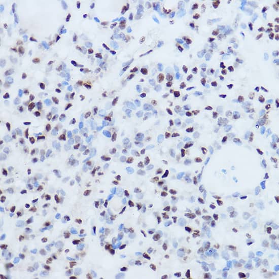 Immunohistochemistry: SSB Antibody [NBP3-35080] - Immunohistochemistry analysis of paraffin-embedded Human thyroid cancer using SSB Rabbit pAb at dilution of 1:300 (40x lens). High pressure antigen retrieval performed with 0.01M Citrate Bufferr (pH 6.0) prior to IHC staining.