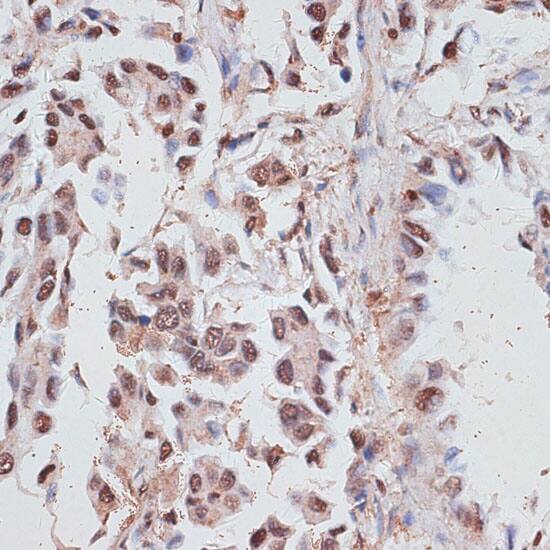 Immunohistochemistry: RPA70 Antibody [NBP3-35085] - Immunohistochemistry analysis of paraffin-embedded Human lung cancer using RPA70 Rabbit pAb at dilution of 1:100 (40x lens). Microwave antigen retrieval performed with 0.01M PBS Buffer (pH 7.2) prior to IHC staining.