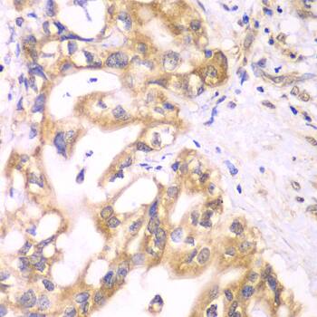 Immunohistochemistry: ACADS Antibody [NBP3-35087] - Immunohistochemistry analysis of paraffin-embedded Human liver cancer using ACADS Rabbit pAb at dilution of 1:100 (40x lens). Microwave antigen retrieval performed with 0.01M PBS Buffer (pH 7.2) prior to IHC staining.