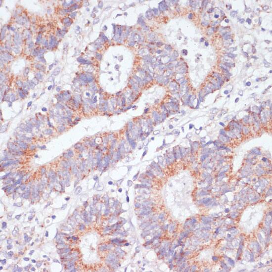 Immunohistochemistry: RAP1A Antibody [NBP3-35089] - Immunohistochemistry analysis of paraffin-embedded Human colon carcinoma using [KO Validated] RAP1A Rabbit pAb at dilution of 1:100 (40x lens). Microwave antigen retrieval performed with 0.01M PBS Buffer (pH 7.2) prior to IHC staining.