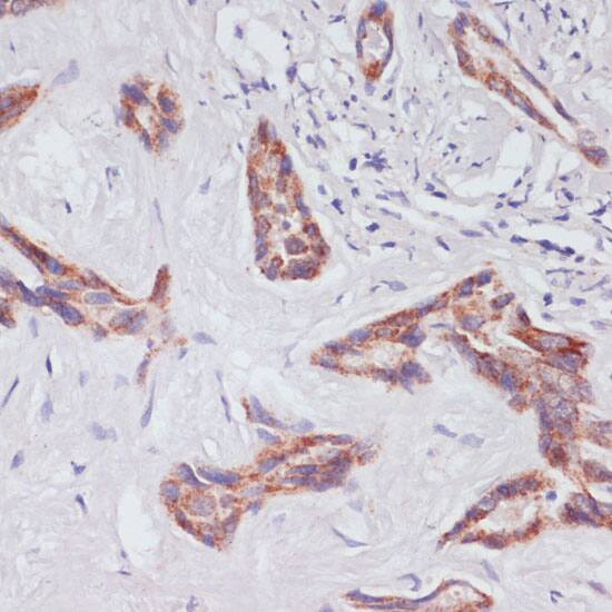 Immunohistochemistry: RAP1A Antibody [NBP3-35089] - Immunohistochemistry analysis of paraffin-embedded Human liver cancer using [KO Validated] RAP1A Rabbit pAb at dilution of 1:100 (40x lens). Microwave antigen retrieval performed with 0.01M PBS Buffer (pH 7.2) prior to IHC staining.