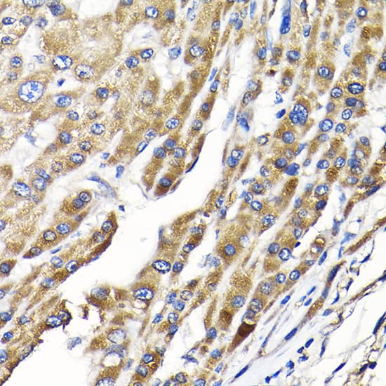 Immunohistochemistry: IKBKAP Antibody [NBP3-35099] - Immunohistochemistry analysis of paraffin-embedded Human liver cancer using IKBKAP Rabbit pAb at dilution of 1:100 (40x lens). High pressure antigen retrieval performed with 0.01M Citrate Bufferr (pH 6.0) prior to IHC staining.