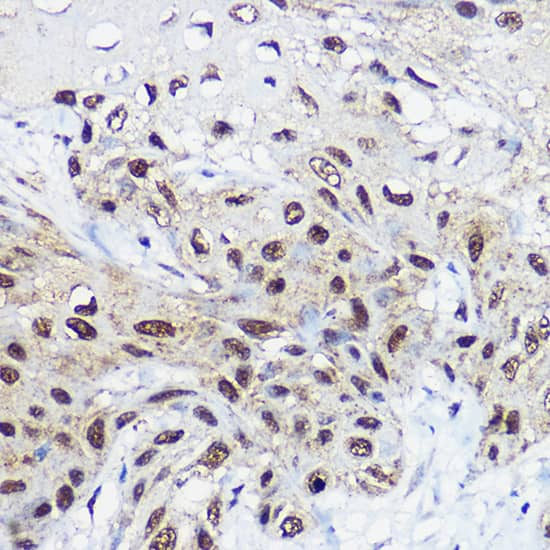 Immunohistochemistry: SMARCA1 Antibody [NBP3-35110] - Immunohistochemistry analysis of paraffin-embedded Human esophageal cancer using SMARCA1 Rabbit pAb at dilution of 1:100 (40x lens). High pressure antigen retrieval performed with 0.01M Citrate Bufferr (pH 6.0) prior to IHC staining.