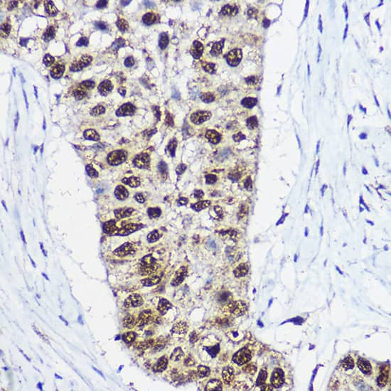 Immunohistochemistry: SMARCA1 Antibody [NBP3-35110] - Immunohistochemistry analysis of paraffin-embedded Human lung cancer using SMARCA1 Rabbit pAb at dilution of 1:100 (40x lens). High pressure antigen retrieval performed with 0.01M Citrate Bufferr (pH 6.0) prior to IHC staining.