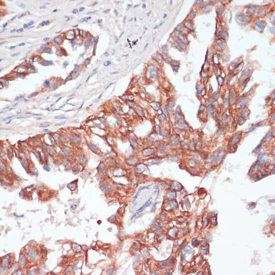 Immunohistochemistry: TIAM1 Antibody [NBP3-35111] - Immunohistochemistry analysis of paraffin-embedded Human lung cancer using TIAM1 Rabbit pAb at dilution of 1:100 (40x lens). Microwave antigen retrieval performed with 0.01M PBS Buffer (pH 7.2) prior to IHC staining.