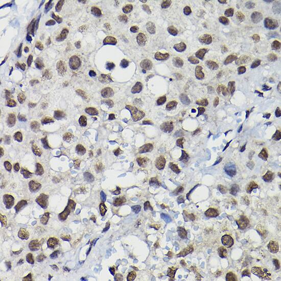 Immunohistochemistry: CCNK Antibody [NBP3-35113] - Immunohistochemistry analysis of paraffin-embedded Human breast cancer using CCNK Rabbit pAb at dilution of 1:100 (40x lens). High pressure antigen retrieval performed with 0.01M Citrate Bufferr (pH 6.0) prior to IHC staining.