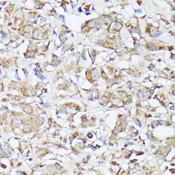 Immunohistochemistry: MTHFD2 Antibody [NBP3-35135] - Immunohistochemistry analysis of paraffin-embedded Human mammary cancer using MTHFD2 Rabbit pAb at dilution of 1:100 (40x lens). Microwave antigen retrieval performed with 0.01M PBS Buffer (pH 7.2) prior to IHC staining.