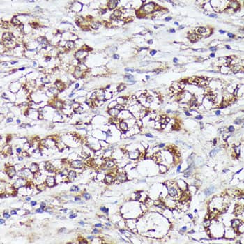 Immunohistochemistry: MTHFD2 Antibody [NBP3-35135] - Immunohistochemistry analysis of paraffin-embedded Human liver cancer using MTHFD2 Rabbit pAb at dilution of 1:100 (40x lens). Microwave antigen retrieval performed with 0.01M PBS Buffer (pH 7.2) prior to IHC staining.