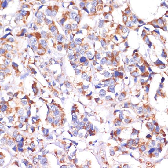 Immunohistochemistry: SLP-2 Antibody [NBP3-35139] - Immunohistochemistry analysis of paraffin-embedded Human breast cancer using SLP-2 Rabbit pAb at dilution of 1:100 (40x lens). Microwave antigen retrieval performed with 0.01M PBS Buffer (pH 7.2) prior to IHC staining.