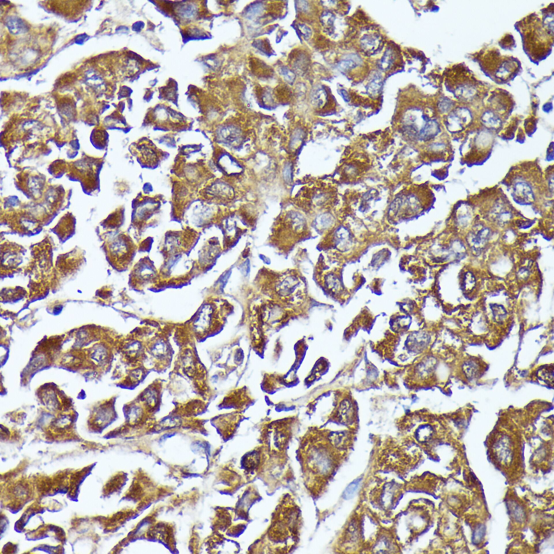 Immunohistochemistry: AKR1C2 Antibody [NBP3-35145] - Immunohistochemistry analysis of paraffin-embedded Human liver cancer using AKR1C2 Rabbit pAb at dilution of 1:100 (40x lens). Microwave antigen retrieval performed with 0.01M PBS Buffer (pH 7.2) prior to IHC staining.