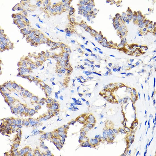 Immunohistochemistry: TST Antibody [NBP3-35150] - Immunohistochemistry analysis of paraffin-embedded Human thyroid cancer using TST Rabbit pAb at dilution of 1:200 (40x lens). High pressure antigen retrieval performed with 0.01M Citrate Bufferr (pH 6.0) prior to IHC staining.