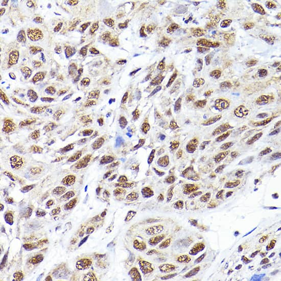 Immunohistochemistry: SEC14L2 Antibody [NBP3-35155] - Immunohistochemistry analysis of paraffin-embedded Human esophageal cancer using SEC14L2 Rabbit pAb at dilution of 1:200 (40x lens). High pressure antigen retrieval performed with 0.01M Citrate Bufferr (pH 6.0) prior to IHC staining.