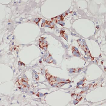 Immunohistochemistry: ACSL3 Antibody [NBP3-35183] - Immunohistochemistry analysis of paraffin-embedded Human mammary cancer using ACSL3 Rabbit pAb at dilution of 1:100 (40x lens). Microwave antigen retrieval performed with 0.01M PBS Buffer (pH 7.2) prior to IHC staining.