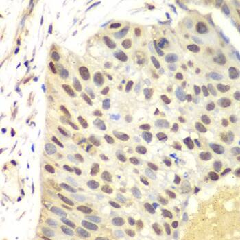 Immunohistochemistry: FEN-1 Antibody [NBP3-35193] - Immunohistochemistry analysis of paraffin-embedded Human lung cancer using FEN-1 Rabbit pAb at dilution of 1:100 (40x lens). Microwave antigen retrieval performed with 0.01M PBS Buffer (pH 7.2) prior to IHC staining.