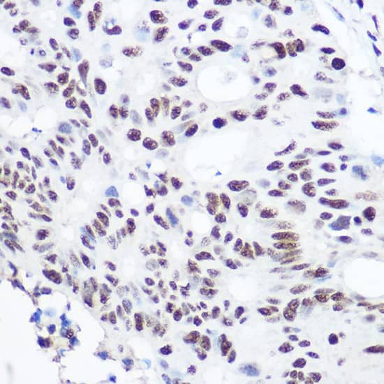 Immunohistochemistry: SART3 Antibody [NBP3-35220] - Immunohistochemistry analysis of paraffin-embedded Human colon carcinoma using SART3 Rabbit pAb at dilution of 1:100 (40x lens). High pressure antigen retrieval performed with 0.01M Citrate Bufferr (pH 6.0) prior to IHC staining.