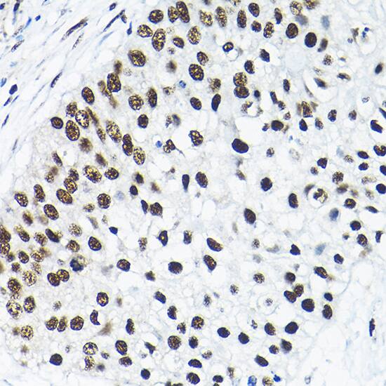 Immunohistochemistry: SNRPA1 Antibody [NBP3-35226] - Immunohistochemistry analysis of paraffin-embedded Human lung cancer using SNRPA1 Rabbit pAb at dilution of 1:200 (40x lens). High pressure antigen retrieval performed with 0.01M Citrate Bufferr (pH 6.0) prior to IHC staining.