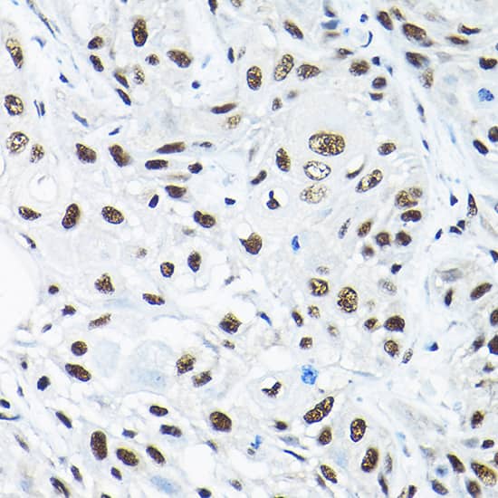 Immunohistochemistry: SNRPA1 Antibody [NBP3-35226] - Immunohistochemistry analysis of paraffin-embedded Human esophageal cancer using SNRPA1 Rabbit pAb at dilution of 1:200 (40x lens). High pressure antigen retrieval performed with 0.01M Citrate Bufferr (pH 6.0) prior to IHC staining.