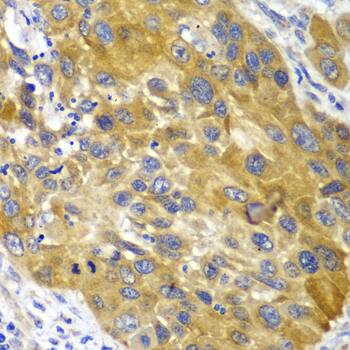 Immunohistochemistry: Adenylate Kinase 1 Antibody [NBP3-35229] - Immunohistochemistry analysis of paraffin-embedded Human esophageal cancer using Adenylate Kinase 1 Rabbit pAb at dilution of 1:100 (40x lens). Microwave antigen retrieval performed with 0.01M PBS Buffer (pH 7.2) prior to IHC staining.