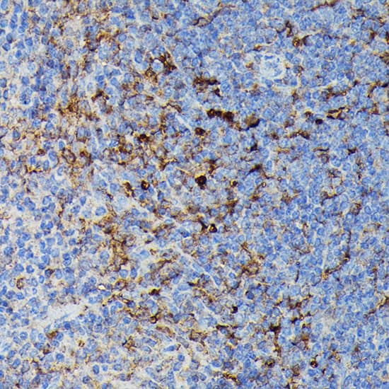 Immunohistochemistry: HLA DPB1 Antibody [NBP3-35275] - Immunohistochemistry analysis of paraffin-embedded Human liver cancer using HLA DPB1 Rabbit pAb at dilution of 1:100 (40x lens). High pressure antigen retrieval performed with 0.01M Citrate Bufferr (pH 6.0) prior to IHC staining.