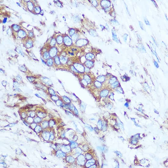 Immunohistochemistry: GSTT1 Antibody [NBP3-35280] - Immunohistochemistry analysis of paraffin-embedded Human breast cancer using GSTT1 Rabbit pAb at dilution of 1:100 (40x lens). Microwave antigen retrieval performed with 0.01M PBS Buffer (pH 7.2) prior to IHC staining.