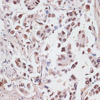 Immunohistochemistry: DKC1 Antibody [NBP3-35287] - Immunohistochemistry analysis of paraffin-embedded Human lung cancer using DKC1 Rabbit pAb at dilution of 1:100 (40x lens). Microwave antigen retrieval performed with 0.01M PBS Buffer (pH 7.2) prior to IHC staining.