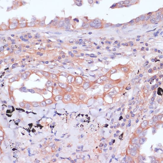 Immunohistochemistry: RPL32 Antibody [NBP3-35299] - Immunohistochemistry analysis of paraffin-embedded Human lung cancer using RPL32 Rabbit pAb at dilution of 1:100 (40x lens). Microwave antigen retrieval performed with 0.01M PBS Buffer (pH 7.2) prior to IHC staining.