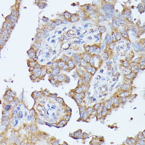 Immunohistochemistry: Histidase Antibody [NBP3-35300] - Immunohistochemistry analysis of paraffin-embedded Human lung cancer using Histidase Rabbit pAb at dilution of 1:100 (40x lens). Microwave antigen retrieval performed with 0.01M PBS Buffer (pH 7.2) prior to IHC staining.