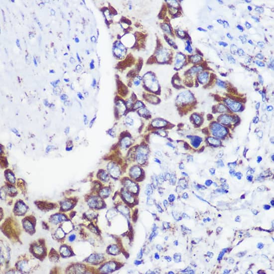 Immunohistochemistry: MTMR9 Antibody [NBP3-35315] - Immunohistochemistry analysis of paraffin-embedded Human lung cancer using MTMR9 Rabbit pAb at dilution of 1:100 (40x lens). Microwave antigen retrieval performed with 0.01M PBS Buffer (pH 7.2) prior to IHC staining.