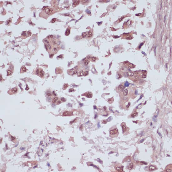 Immunohistochemistry: U2AF35 Antibody [NBP3-35321] - Immunohistochemistry analysis of paraffin-embedded Human lung cancer using U2AF35 Rabbit pAb at dilution of 1:100 (40x lens). Microwave antigen retrieval performed with 0.01M PBS Buffer (pH 7.2) prior to IHC staining.